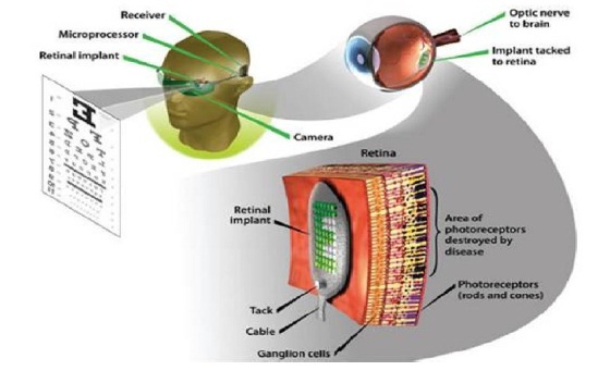 Artificial retina for blind people